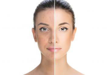 Pickel und Unreinheiten Before & After | INCEBEL Medical Beauty Institut