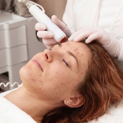 Skin Anti-Akne Cold Plasma