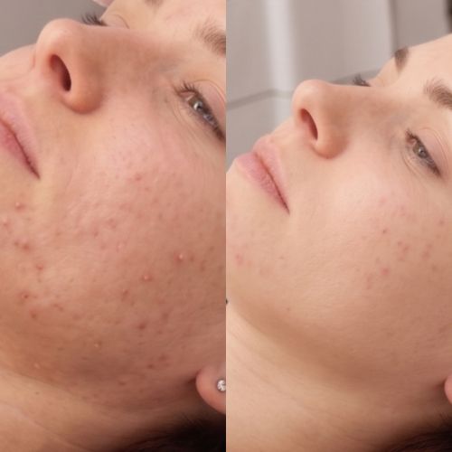 Skin Anti-Akne Cold Plasma