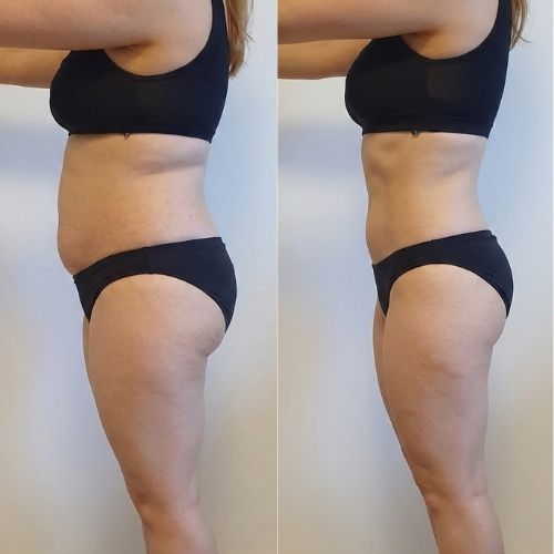 Body Shaping Fettzellenabbau