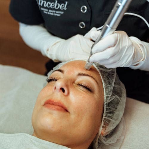 Skin Renew Microneedling