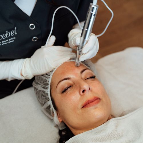 Skin Renew Microneedling